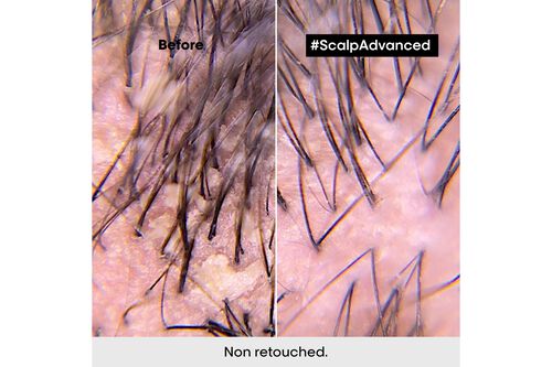 Scalp Advanced Anti-Dandruff Shampoo - Serie Expert Retailers | L'Oréal Partner Shop