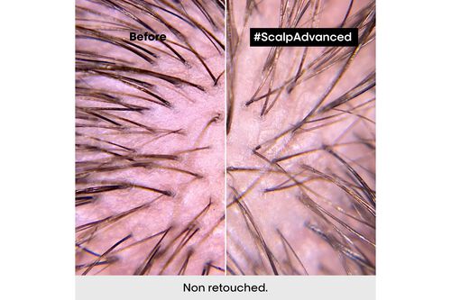 Scalp Advanced Anti-Discomfort Shampoo - L'Oreal Professionnel | L'Oréal Partner Shop